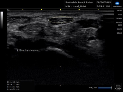 Ultrasound Left Median Nerve